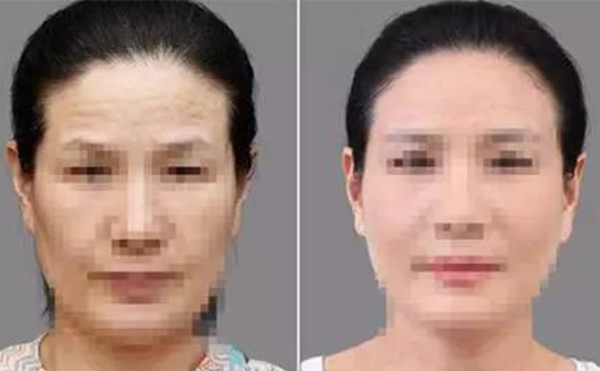 激光除皺有什么優(yōu)勢？