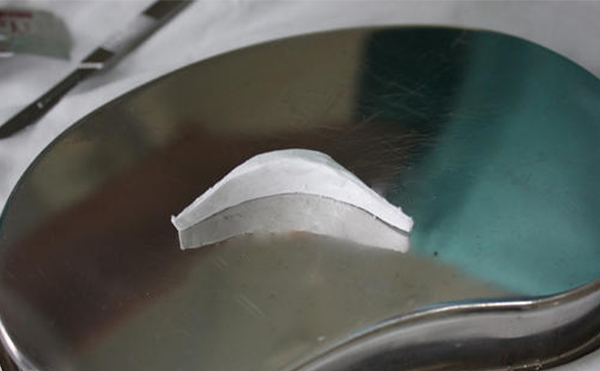 膨體豐下巴術(shù)后下巴的手感真實(shí)嗎?術(shù)后如何護(hù)理?