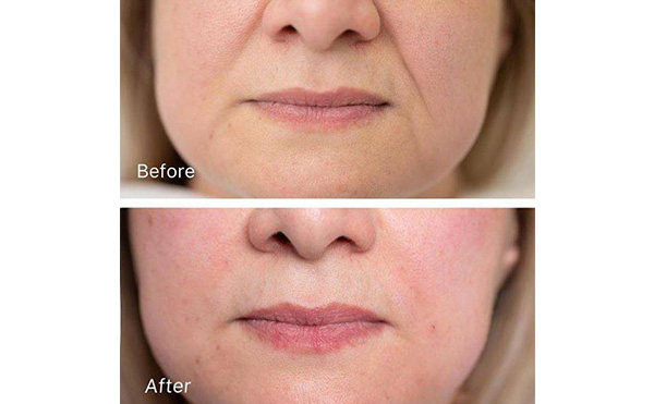 玻尿酸去法令紋安全嗎？