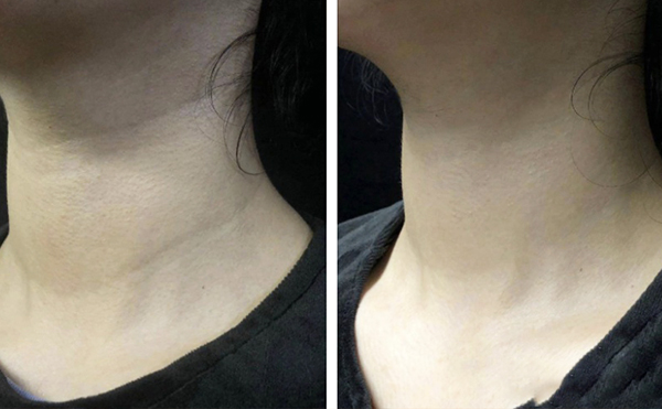 超聲刀怎么去除頸紋?效果怎么樣?