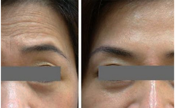 玻尿酸去抬頭紋能維持多久？