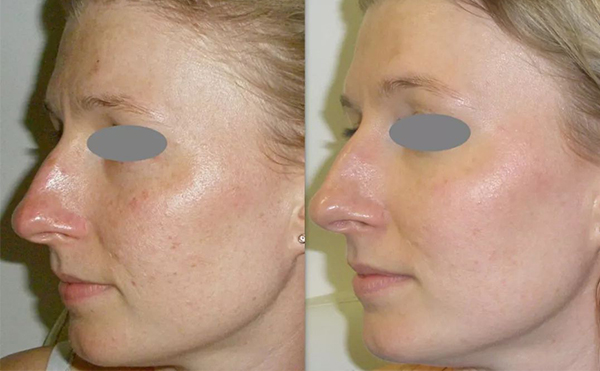 光子嫩膚價(jià)格受哪些因素影響？