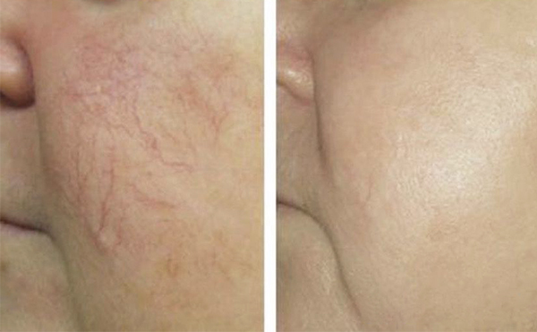 彩光嫩膚疼不疼？