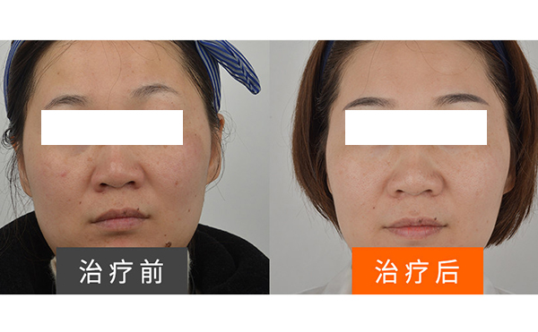 彩光嫩膚安全不安全？