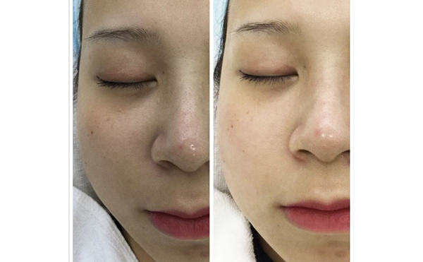 激光祛斑有哪些誤區(qū)？