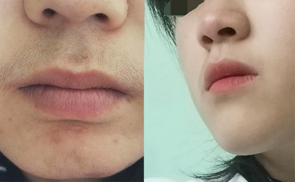 激光脫毛的效果怎么樣？