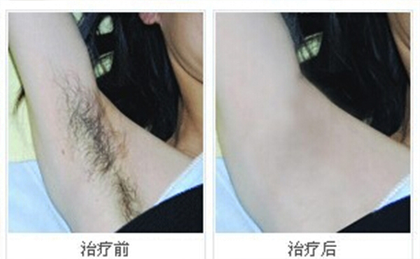 冰點(diǎn)脫腋毛安全嗎？