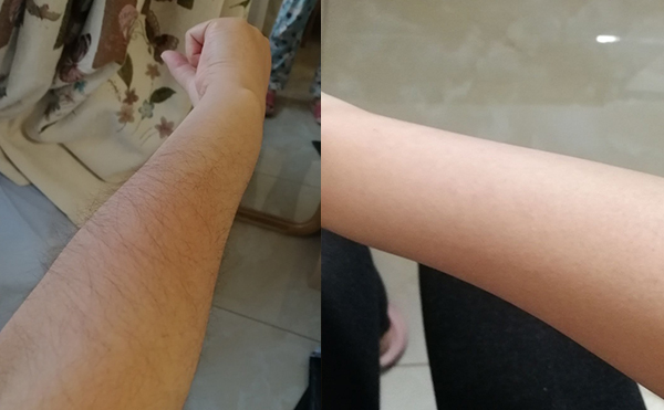 光子手臂脫毛幾次能脫完？