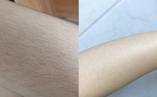 激光手臂脫毛安全嗎？