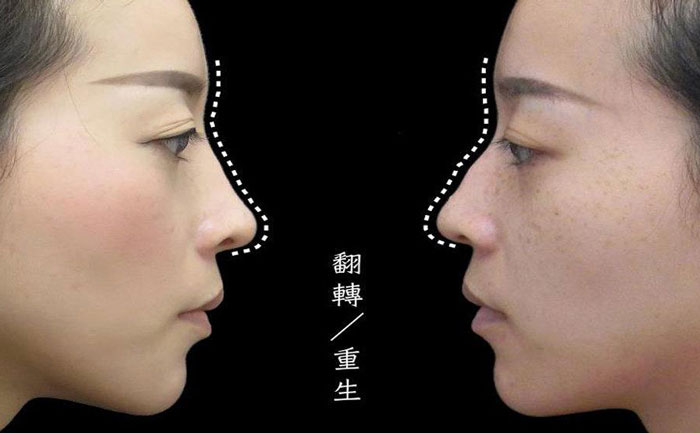 駝峰鼻矯正多少錢？駝峰鼻矯正有危險(xiǎn)嗎？