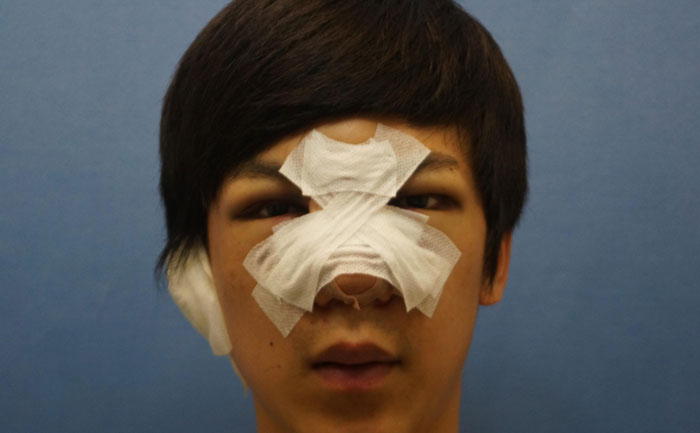 駝峰鼻矯正手術(shù)多少錢？駝峰鼻矯正有危險(xiǎn)嗎？