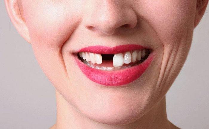 補(bǔ)門(mén)牙缺口大概多少錢(qián)？補(bǔ)門(mén)牙后一般能維持幾年？