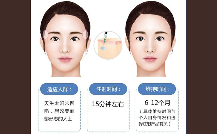 玻尿酸豐太陽穴一般幾支？