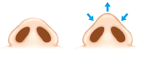 術(shù)后變成了朝天鼻