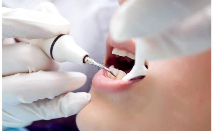 超聲洗牙價格是多少？超聲洗牙對牙齒有傷害嗎？