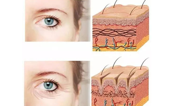 自體脂肪填充眼瞼凹陷效果怎么樣?有哪些注意事項?