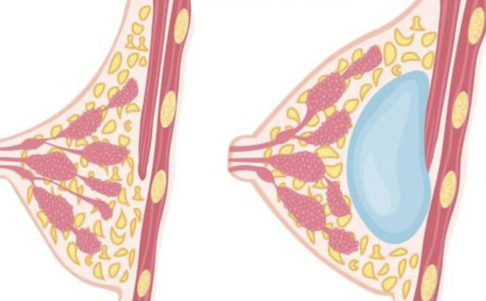 硅膠假體豐胸需要多少錢？硅膠假體豐胸可以保持多久？