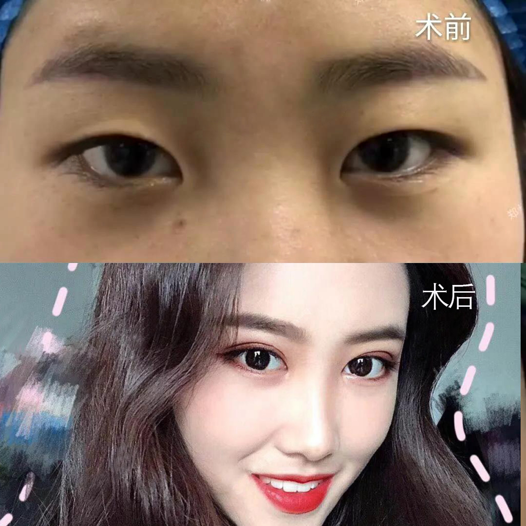 于世川做雙眼皮案例效果對(duì)比圖