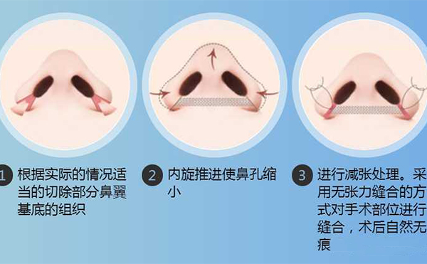 鼻翼縮小手術(shù)有用嗎？