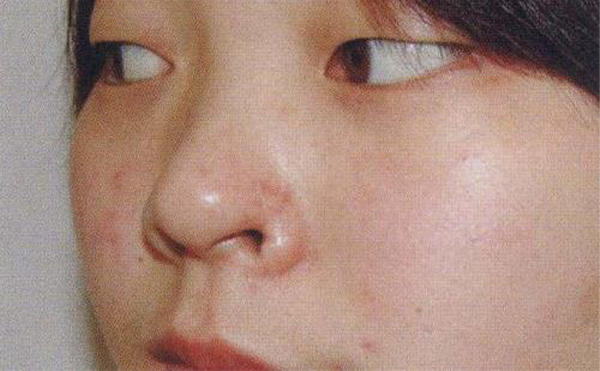 鼻翼缺損是怎么修復(fù)的？鼻翼缺損的修復(fù)效果怎么樣