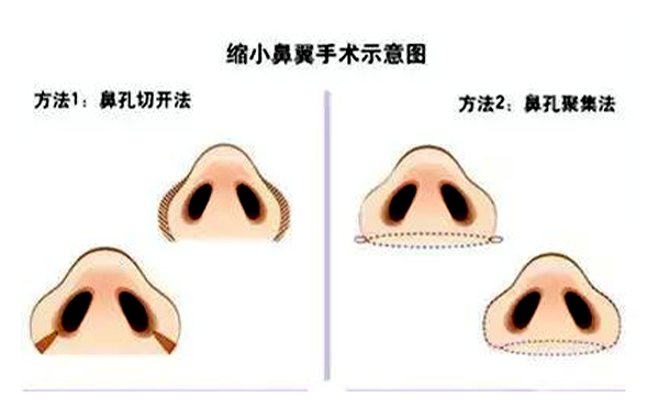  鼻翼縮小有后遺癥嗎？會不會反彈