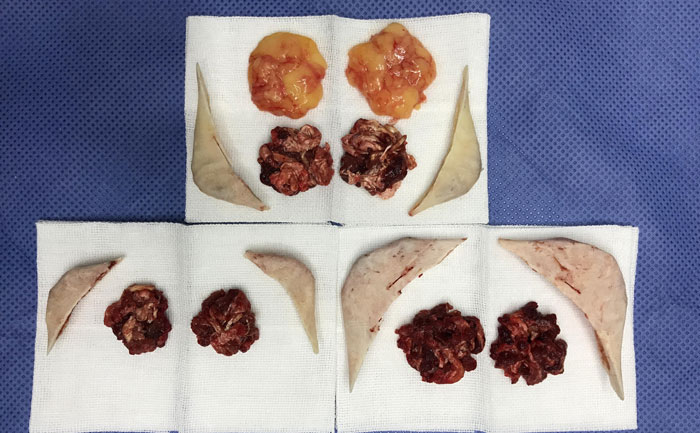 磨骨瘦臉費(fèi)用多少錢？