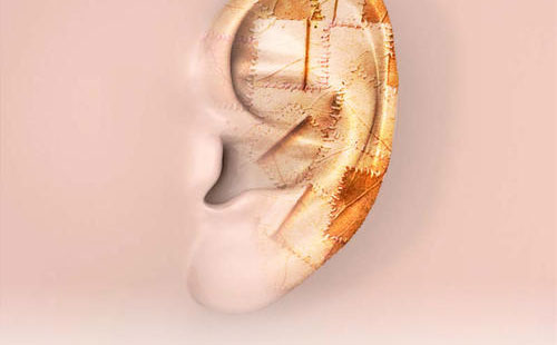 全耳再造術(shù)多少錢？全耳再造需要多久時(shí)間？