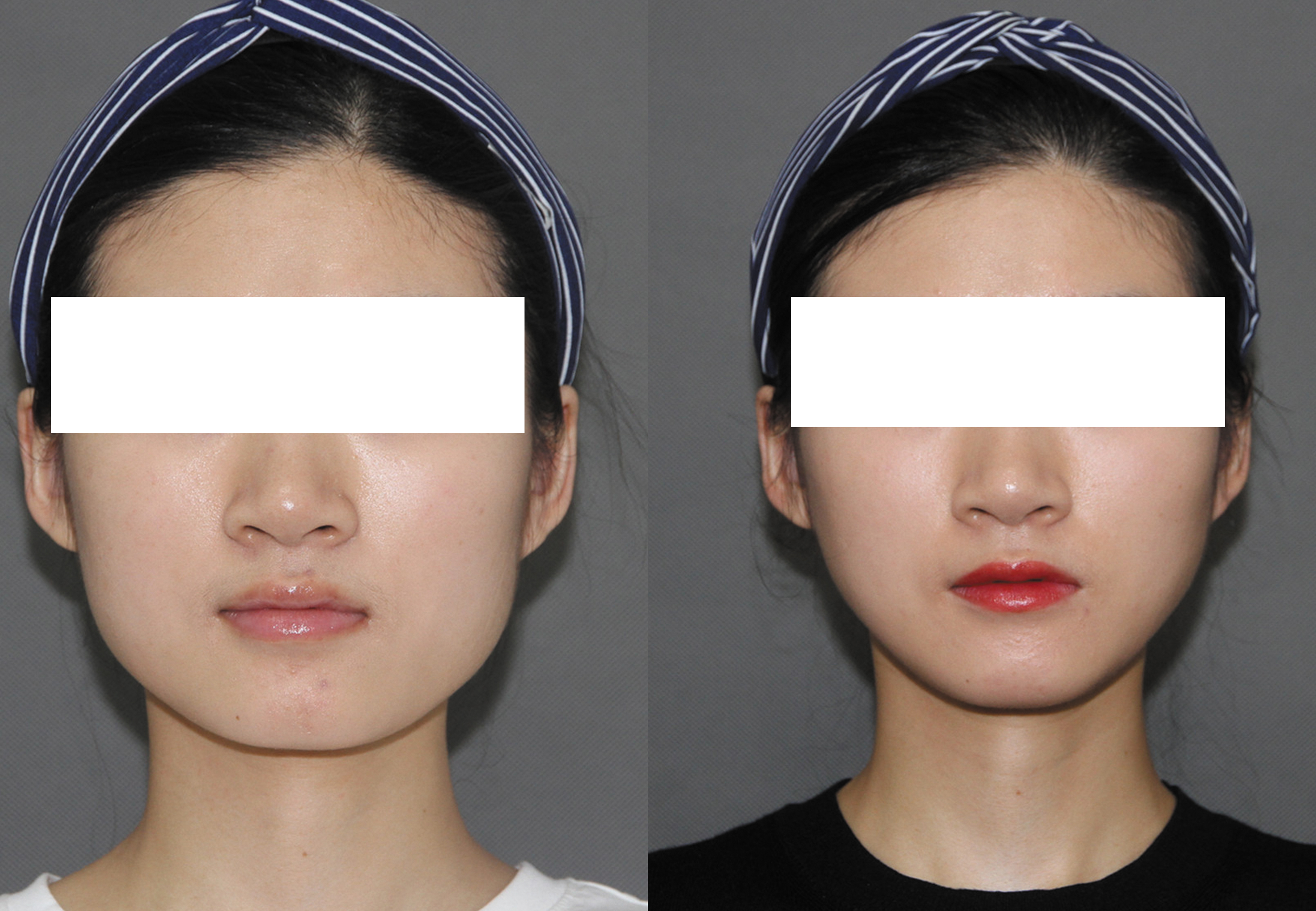 合肥藝星周海林醫(yī)生手術(shù)效果圖3