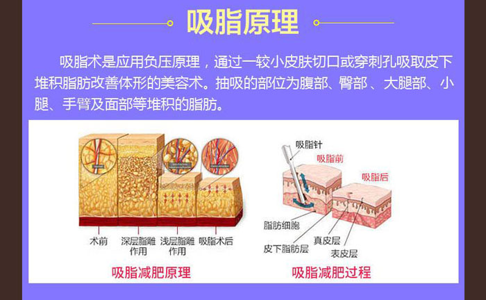 水動力吸脂效果好嗎？