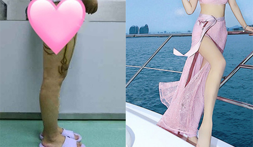 大腿吸脂效果對(duì)比