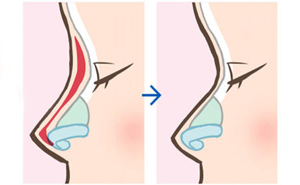 隆鼻假體什么時(shí)候取出較好?更換的話是必須要換新的嗎?