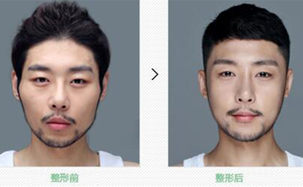 顴骨整形手術(shù)風險有多大?