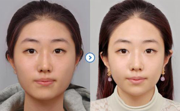 瘦臉針注射后注意事項(xiàng)