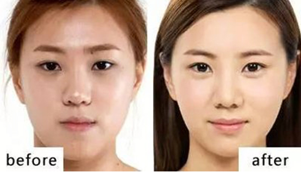 自體脂肪豐臥蠶有什么優(yōu)勢?能維持多久?