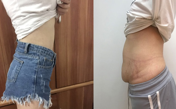 腹壁成形術(shù)效果怎么樣?術(shù)后效果不明顯可以再次手術(shù)嗎?