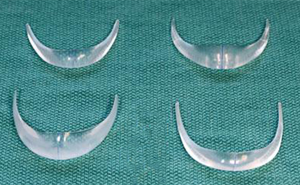 做了假體下巴幾天能消腫?時間久了假體會硬化嗎?