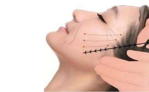 線雕提升適合哪些人做？