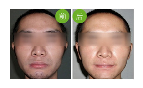 冰點(diǎn)面部脫毛值得做嗎？