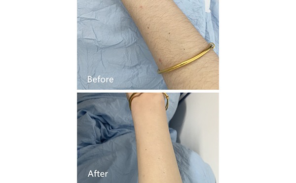 激光脫毛的影響因素有哪些?