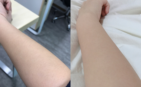 冰點(diǎn)脫毛有什么優(yōu)勢(shì)？