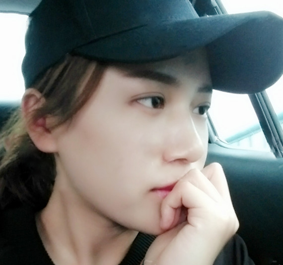 全臉脂肪填充效果術后2周效果圖