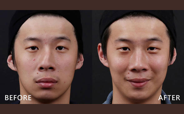 鼻骨矯正手術(shù)多少錢？鼻骨矯正手術(shù)危險(xiǎn)嗎？