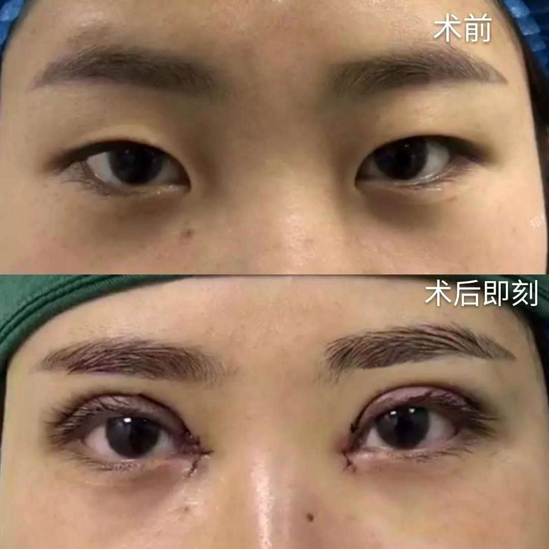 于世川做雙眼皮案例效果對(duì)比圖2