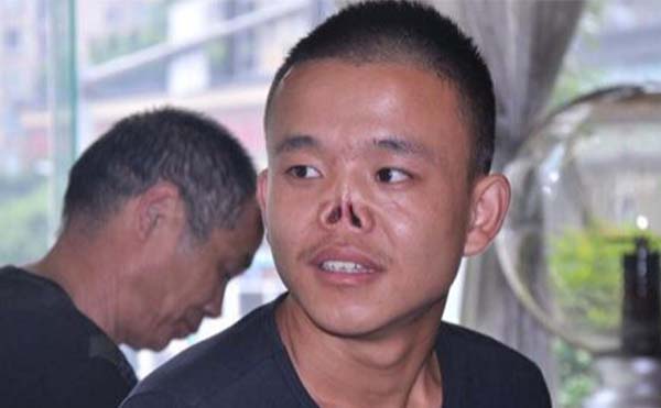 鼻再造手術(shù)有什么風(fēng)險(xiǎn)?