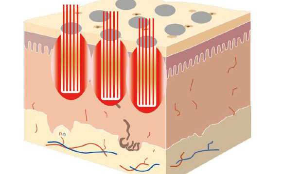 點(diǎn)陣激光祛斑后多久消失？