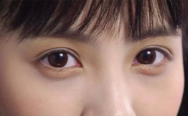 豐臥蠶的手術(shù)過程是什么?術(shù)后會(huì)不會(huì)留疤?