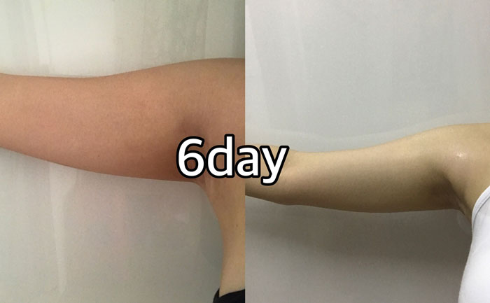 手臂吸脂多少錢