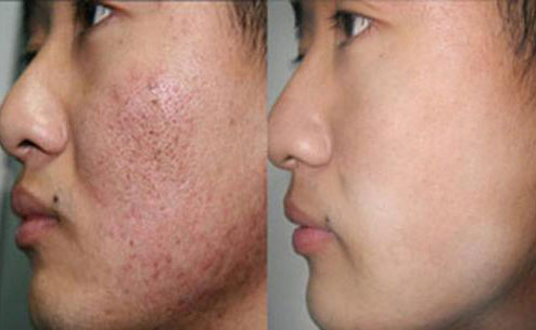 痘坑修復(fù)激光手術(shù)大概要多少錢？