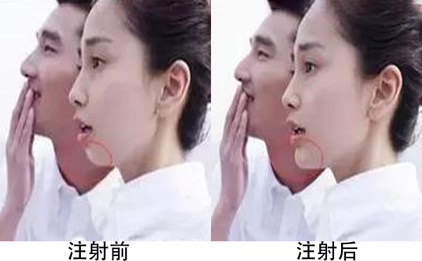 膨體隆下巴容易引發(fā)感染嗎?恢復(fù)后手術(shù)切口會(huì)不會(huì)被人被看出來?