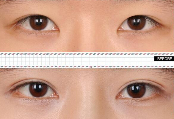 做雙眼皮價(jià)格是多少？哪種眼睛適合做雙眼皮呢?